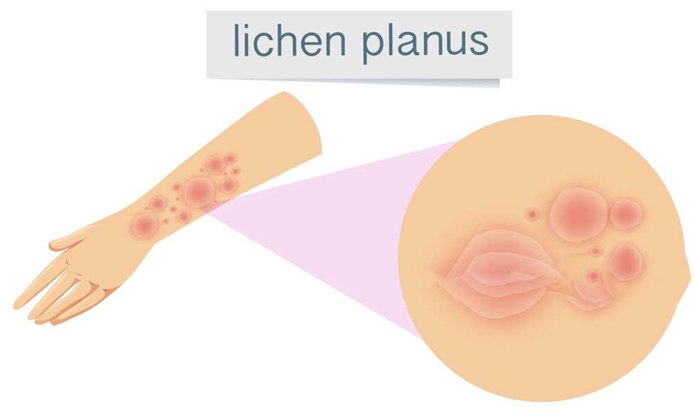Lichen planus treatment
