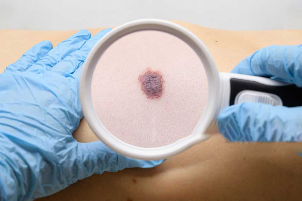 Melanoma treatment