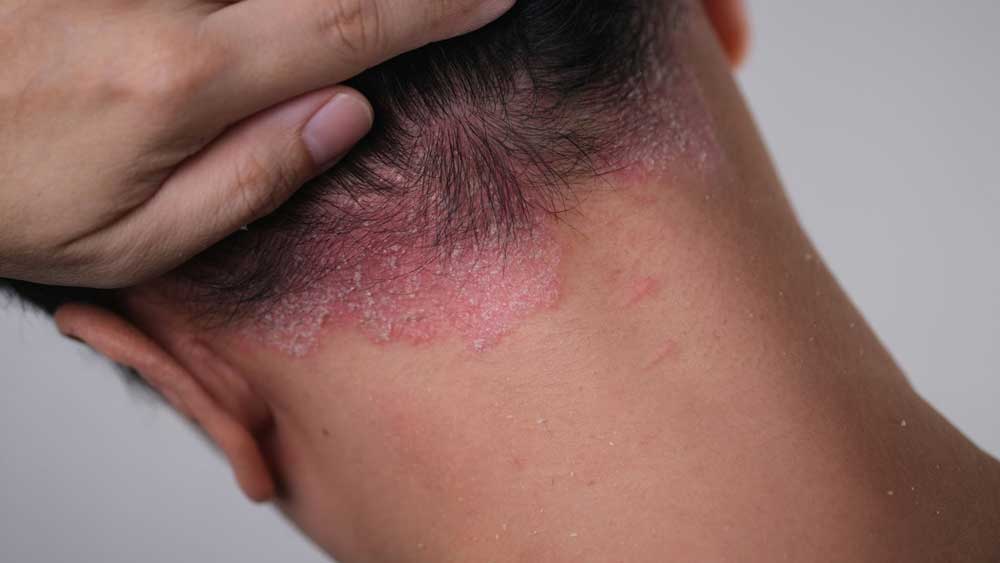 Psoriasis treatment
