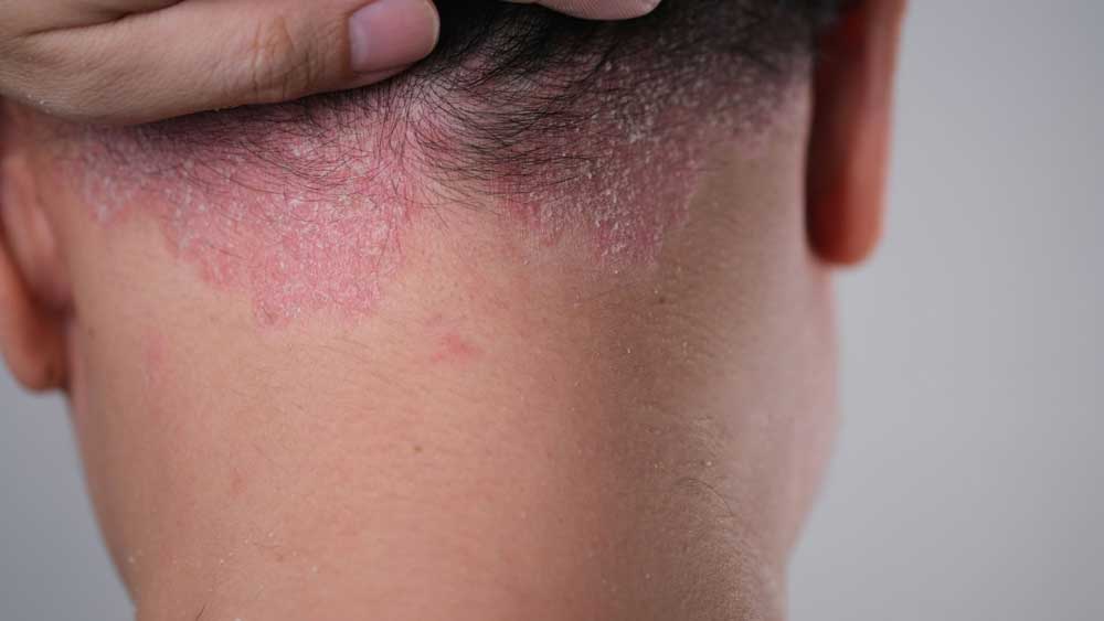 Seborrheic dermatitis treatment