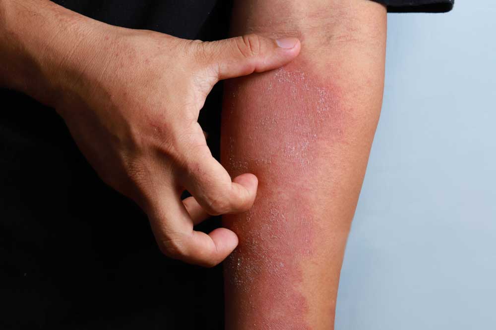 Eczema treatment