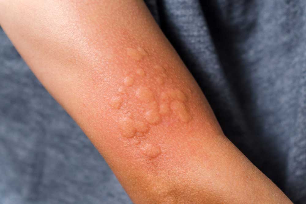 Hives treatment